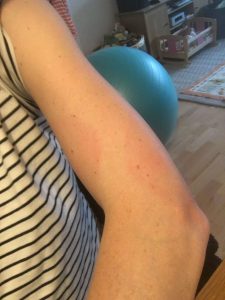 Large EM Rash showing on Lesley's upper arm.