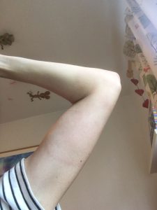 Larger EM rash expanding across Lesley's left upper arm.