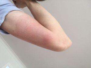Large, red EM rash on Lesley's left arm.