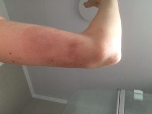 Large EM rash on Lesley's arm showing red mark at original bite location.