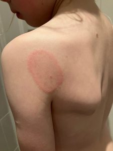 Young girl with EM rash on the back of her left shoulder.