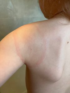 Little girl with large EM rash on her back left shoulder.