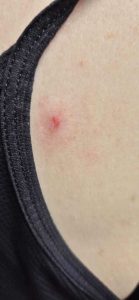A small red mark at the site of the tick bite.