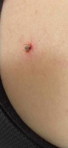 Embedded tick.