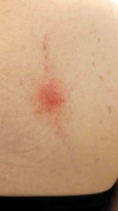 Expanding erythema migrans rash.
