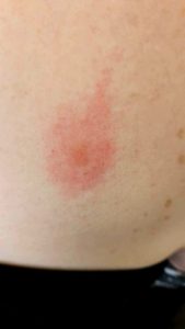 Growing erythema migrans rash.