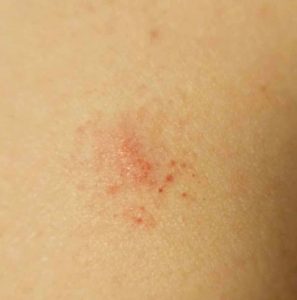 Early erythema migrans rash.