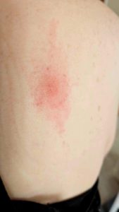 Large erythema migrans rash.