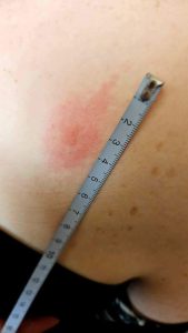 Measuring tape showing size of an expanding EM rash.