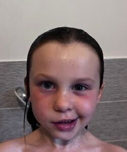 Ella with facial palsy.