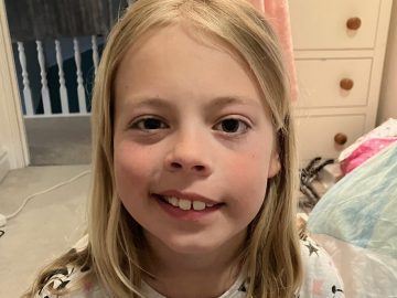 Danielle with facial palsy.
