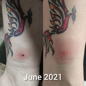 Side-by-side photos of Maja's 2021 tick bite showing the embedded tick (left) and the resulting EM rash (right).