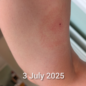 Maja's 2025 tick bite and expanding EM rash.